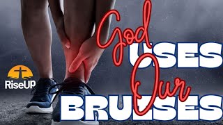 God uses our bruises